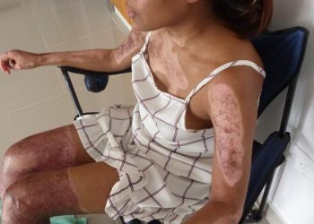 Testimonio de una joven que salvó su vida de milagro, tras una explosión por un escape de GLP
