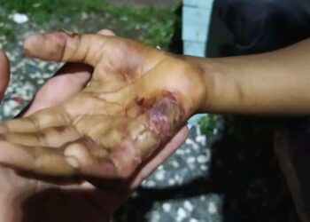 Denuncian madre tortura hija quemando manos en estufa por la rotura de celular